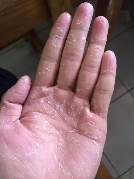 猜你喜欢推荐手掌手指脚底掉皮干燥脱皮起皮蜕皮爆皮褪皮退皮膏