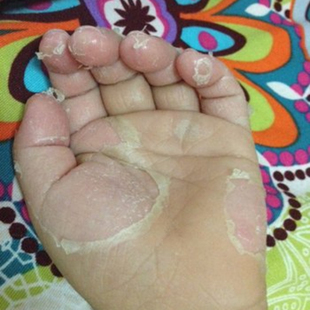 季节性手脚脱皮药干燥儿童手掌心手指头剥脱性角质松懈症抑菌专用