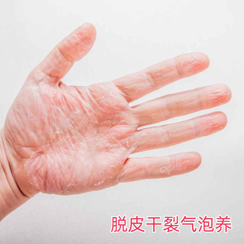 手上长水泡痒手汗起疹膏手指上起脱皮干裂皮肤过敏水泡手痒小专膏
