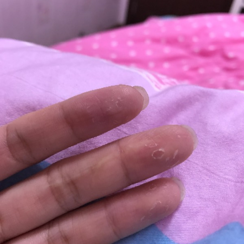 手指脱皮掉皮手掌干燥起皮秋冬季手部护理草本抑菌膏手足脱皮软膏