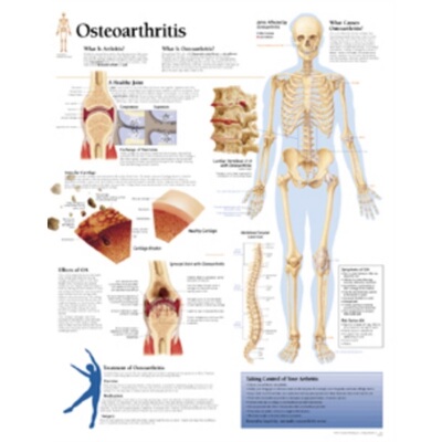 预订不退不换Osteoarthritis Paper Poster[9781930633148]