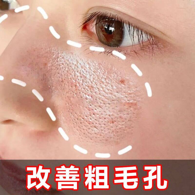 爽肤水补水保湿控油黑头闭口院用大容量湿敷水收缩毛孔粗大精华液