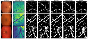 DL00622-使用残差注意力机制UNET进行视网膜血管语义分割完整代码