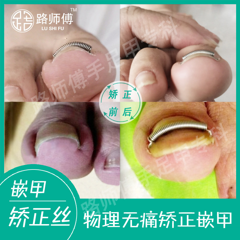 矫正嵌甲脚趾甲神器修指甲刀