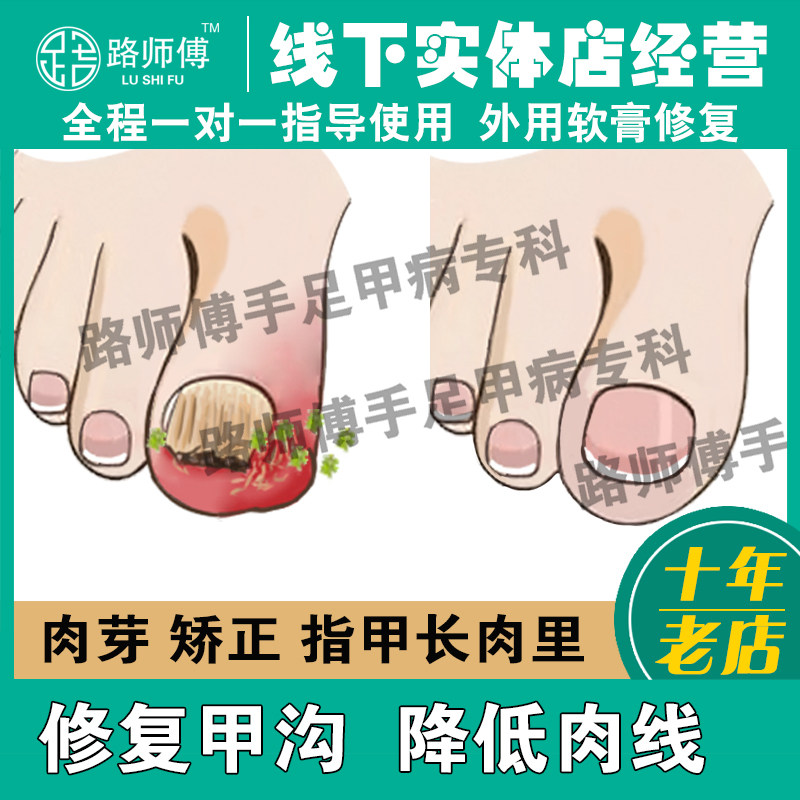 甲沟软甲膏息肉去除专用嵌甲矫正医用用具