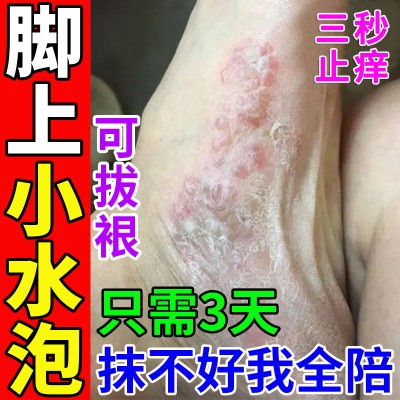 脚痒烂脚丫脚臭出汗小水泡