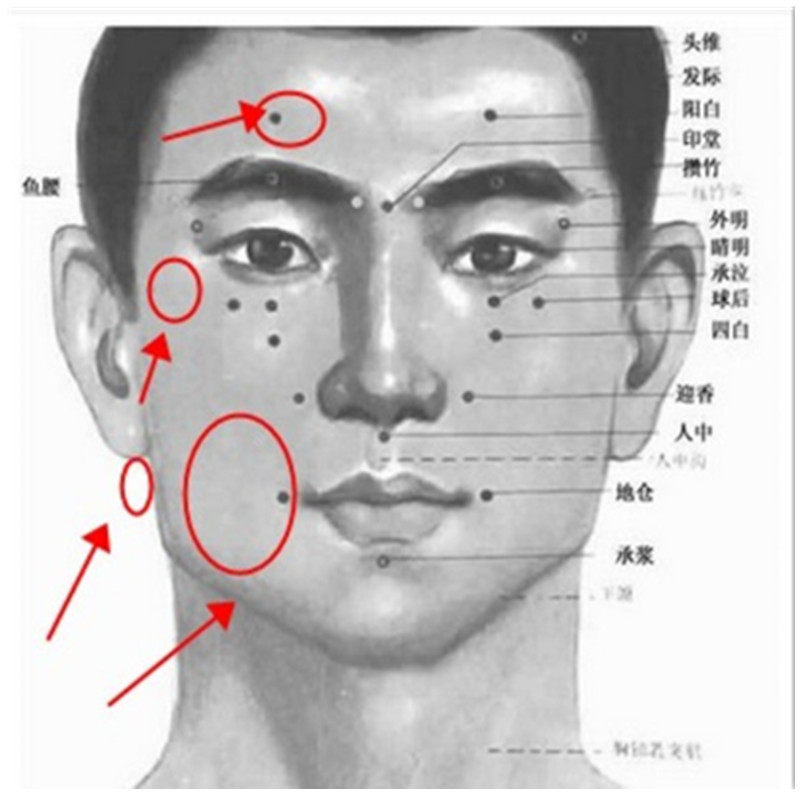 面瘫贴牵正膏后遗症口眼联动嘴歪面肌痉挛加味太乙膏药贴