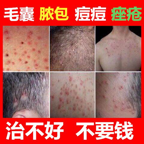 去毛囊有炎治療膿包痤疮祛私处头皮头部背部痘鸡皮肤疙瘩痒药软膏