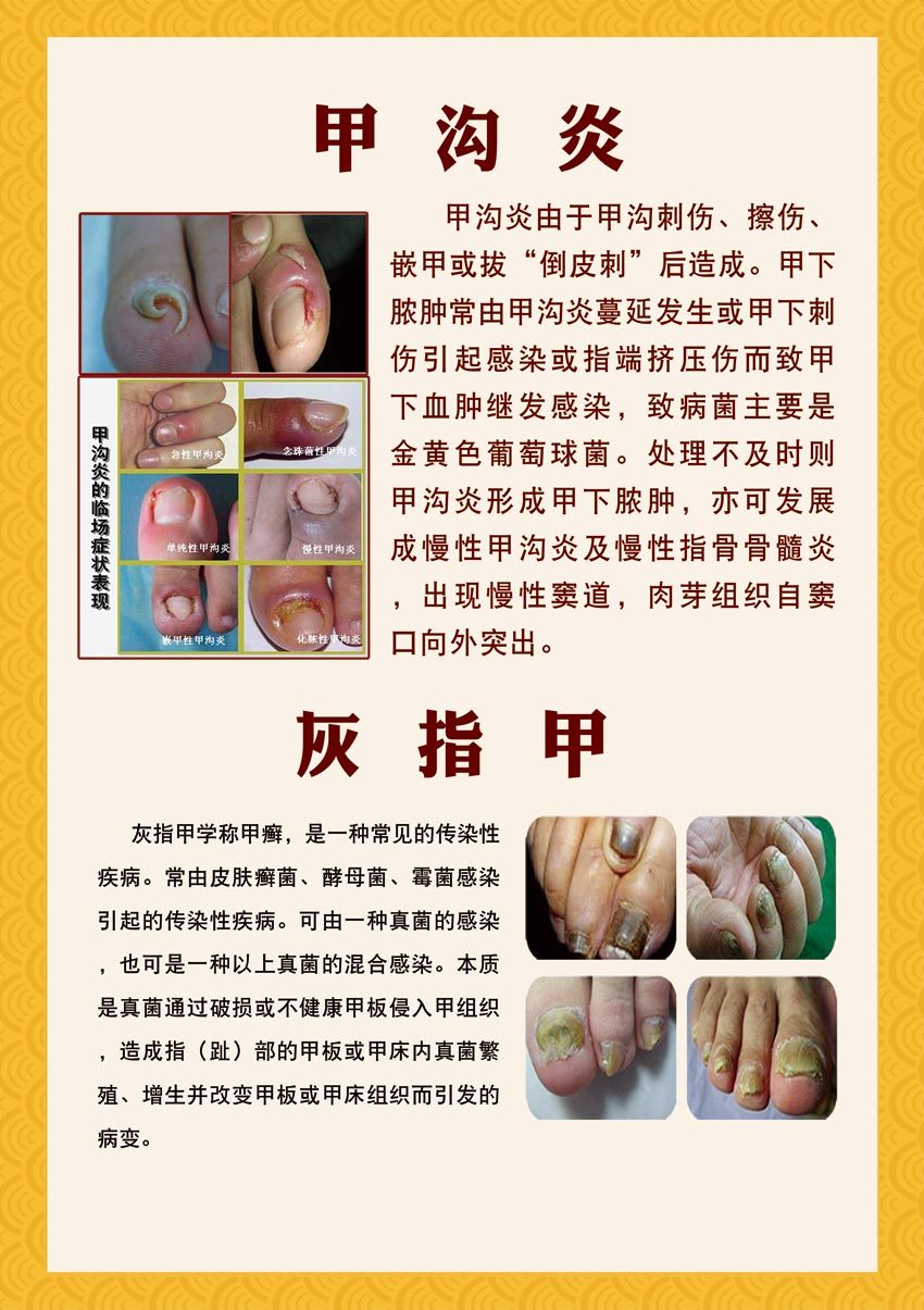 m769足疗修脚甲沟炎灰指甲简介绍危害856海报定制印制展板写真