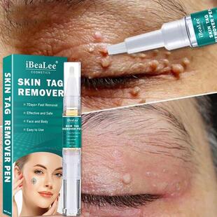 5ml Women Men Skin Tags Remover Painless Skin Dark Spot