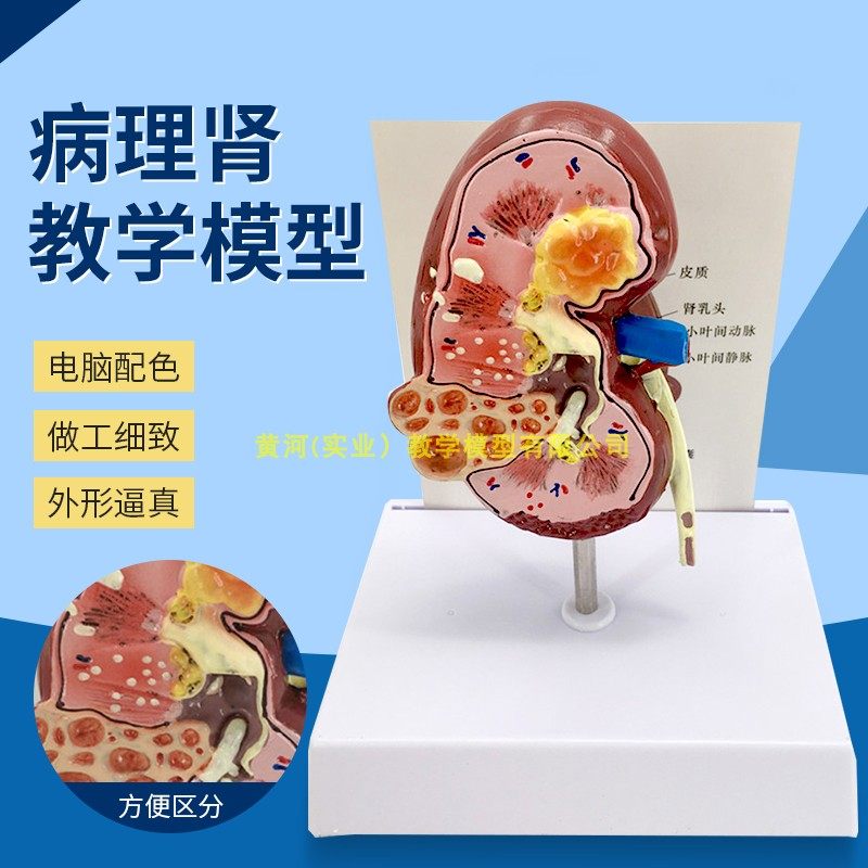 人体病变肾上腺模型肾脏解剖模型肾模型生殖泌尿科 肾病理模型_虎窝淘