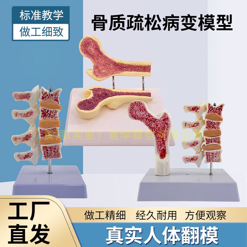 人体股骨头病变比较模型病理骨质疏松演示骨骼骨架玩具医用教学