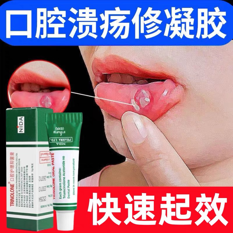 NIDA泰国口腔溃疡凝胶膏嘴巴上火起泡口舌生疮缓解疼痛贴修复黏膜