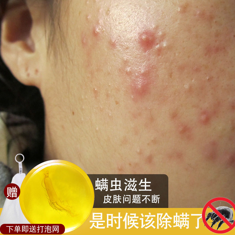 苦参皂除螨皂祛痘面部控油女男脸部全身洗脸手工香皂去螨虫正品