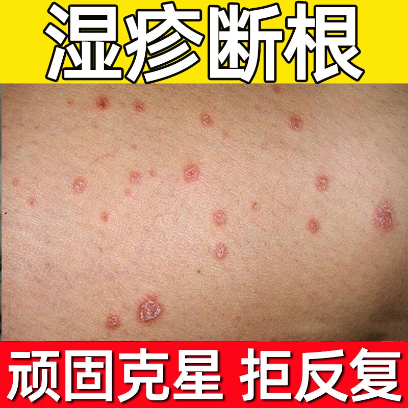 真菌感染手苗药膏治疗干疮的药皮肤瘙痒止痒膏真菌治疗头皮屑的药