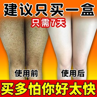 鸡皮肤去除神器改善干燥起皮瘩毛囊疙角化角质鱼鳞蛇霜病身体乳霜