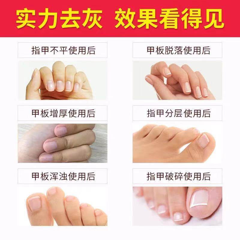 厂家加工灰指甲专用保健液去灰指甲净趾灰指甲护理液足部套装