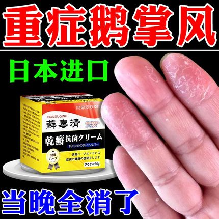 日本进口【可拫冶】鹅掌风手藓膏真菌感染水泡干裂脱皮抑菌止痒膏