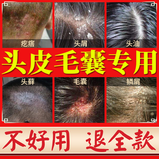 毛囊洗发炎水中药头部专用生姜去屑止痒控油药膏特效康王头皮除螨