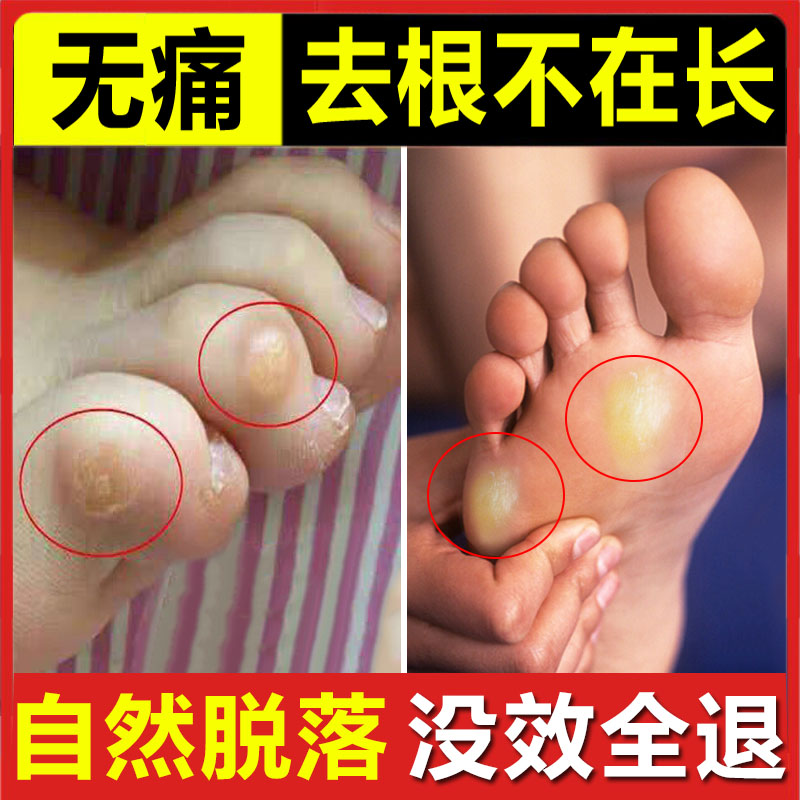 去脚老茧去除神器软化剂