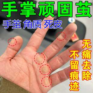 LY01551学生适用老茧处理剂 手掌手指关节厚茧去除神器