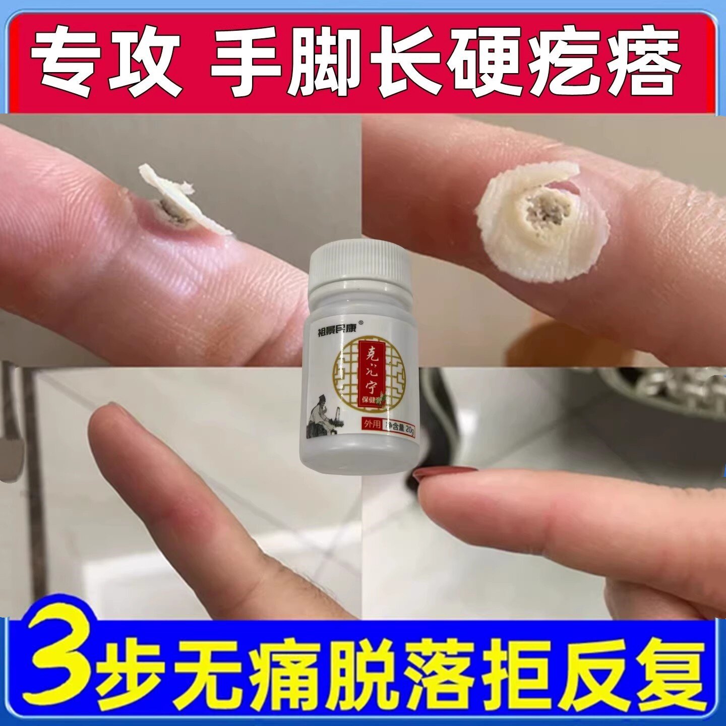 拔脚上长硬疙瘩点猴小肉刺痦子专用膏连根手上刺猴鱼鳞痣去除神器