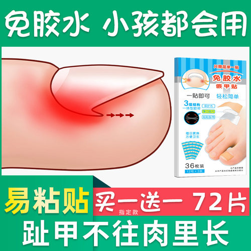 脚趾甲矫正器价格 脚趾甲矫正器图片 星期三