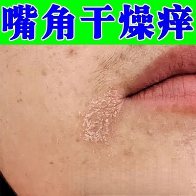 脸干燥起皮嘴角有碎屑脱皮紧绷嘴角脱皮干皮泛红过敏发痒修复药膏