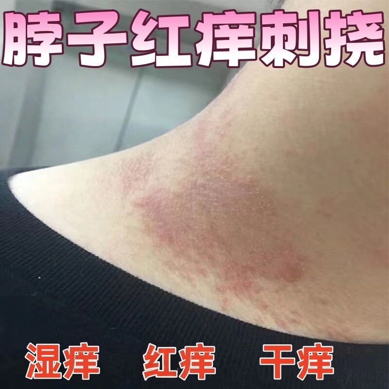 脖子红痒刺挠长疙瘩疹子红肿过敏性皮肤痒湿毒止痒膏脖子出汗过敏