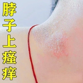 脖子上长鲜红痒药外用皮肤脖子出汗红痒刺挠过敏头皮发痒止痒软膏