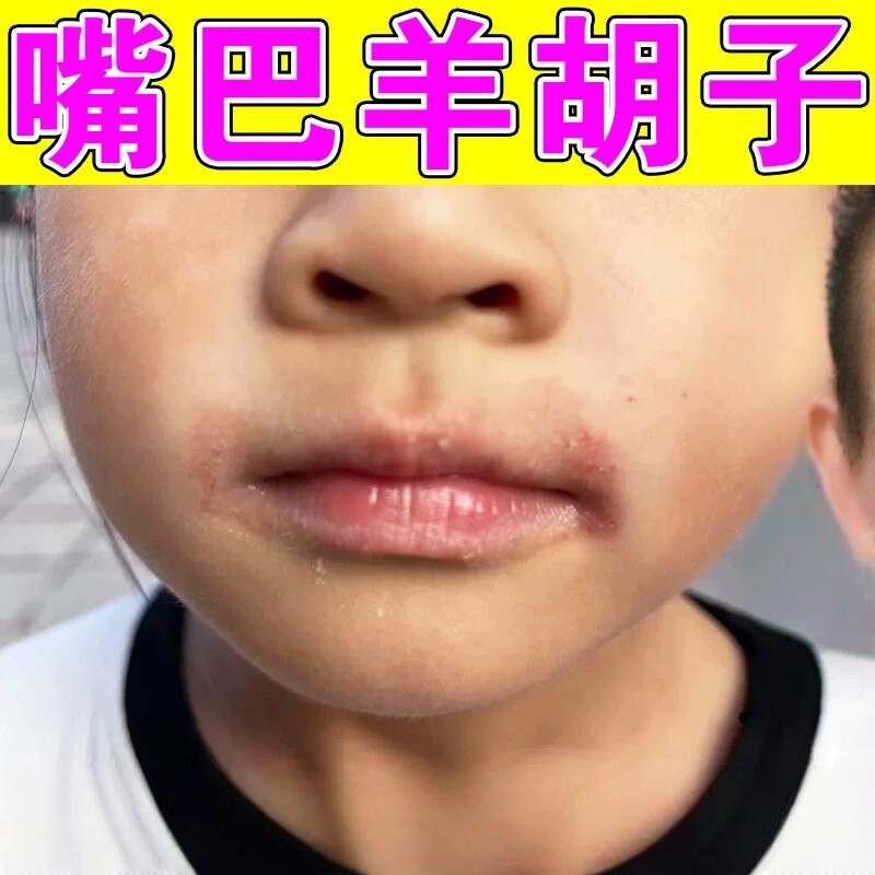 去羊胡子疮儿童舔嘴唇一圈发红肿痛烂嘴角痒干燥起皮干裂唇炎药膏