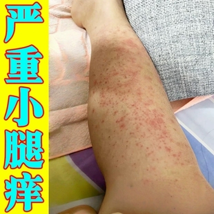 秋冬天小腿皮肤痒药腿上干燥起皮腿部发痒全身长红点疙瘩过敏专用