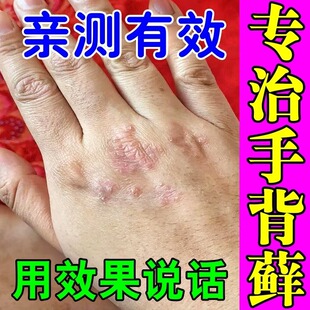 手背上长藓发痒药膏手背干燥裂口脱皮真菌感染湿皮疹炎小疙瘩乳膏