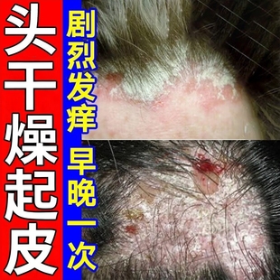 头皮痒膏药真菌感染头屑头痒干燥起皮皮肤发痒起皮屑外用修复乳膏