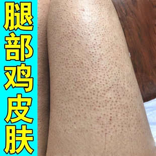 鸡皮肤疙瘩毛囊角化质药膏去除全身腿部粗糙小颗粒黑点毛周角质症