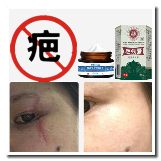 祛手术后撞伤缝针药膏修复液去除增生性突起疙瘩伤疤痕印烟疤斑印