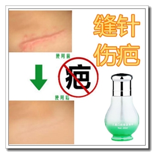淡化男女烟疤擦伤摔伤去除黑色素护理脸面部疤痕愈合修复凸起药膏