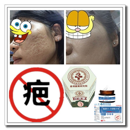 去疙瘩祛儿童增生性凹凸除手术烟烫烧伤药疤痕印激光缝针抓伤摔伤