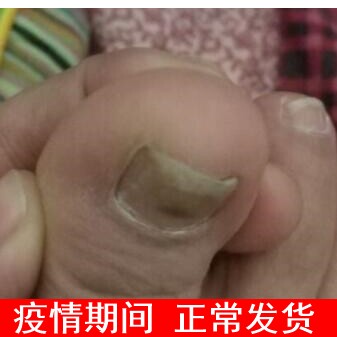 李广华手脚灰指趾之甲趾癣液原装套装杀菌脱指甲增厚起粉变色好
