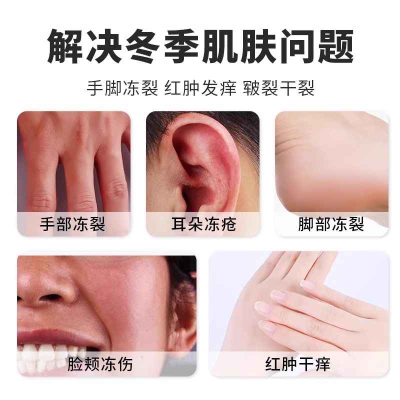 冻伤膏冻正品防冻防裂疮膏霜儿童耳朵脸冻手部脚膏冬季足男女专用