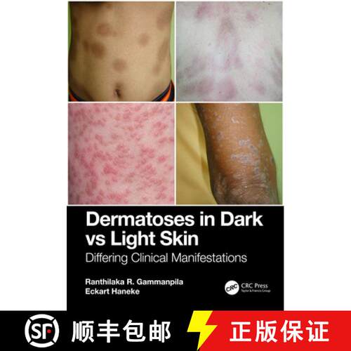 【3-4周达】Dermatoses in Dark Vs Light Skin: Differing Clinical Manifestations [9781032762739]
