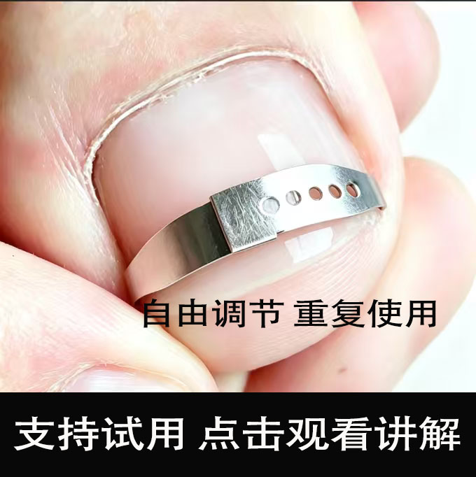脚趾甲扎肉嵌甲正甲扣拉拉贴牵引矫正器正价贴垫片物理牵引