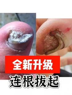 灰指黄厚发白凹凸不平白点黑点缺一半少一块