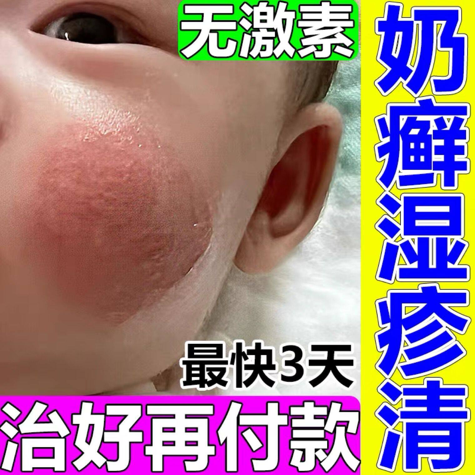 湿诊婴儿专用宝宝口水疹热疹奶藓婴幼儿干性儿童白色糠疹止痒去跟