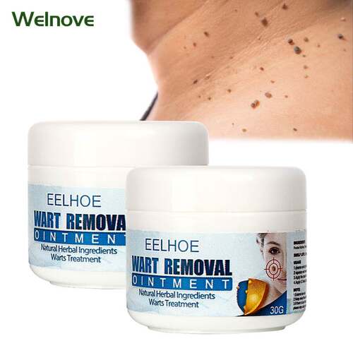 30g Skin Tag Remover Cream Warts Mole Remove Ointment Antiba