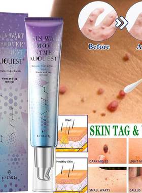 Treatment Papillomas Removal of Warts Cream Plantar Genital