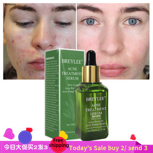 Treatment men Serum Essence women收缩毛孔精华液 Facial Acne