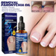 removal toenails paronychia West&Month oil soften Putty Nail