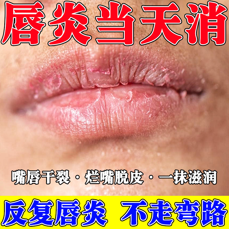 唇膏治唇炎冬天嘴唇干裂炎症儿童嘴唇防干裂脱皮儿童口开裂药膏霜