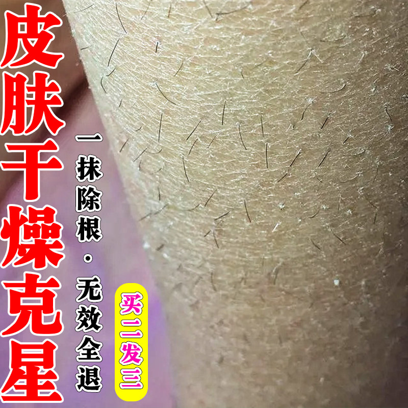 冬季皮肤干燥瘙痒腿上起皮掉皮男生小腿皮屑粗糙鱼鳞蛇鳞肤专用药